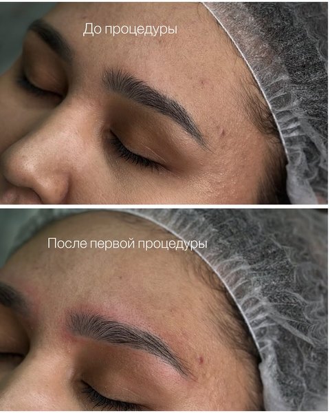 Быстро, качественно и без боли — удаление в Актобе